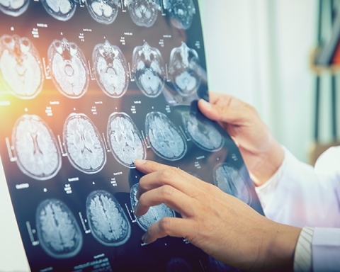 hands point at MRI (Xray) brain scan